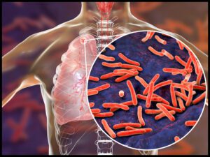 Tuberculosis outbreak in North Carolina