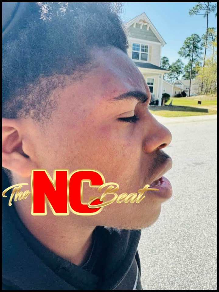 The Overhills High School student who was attacked by multiple girls suffered a swollen eye and visible scratches.