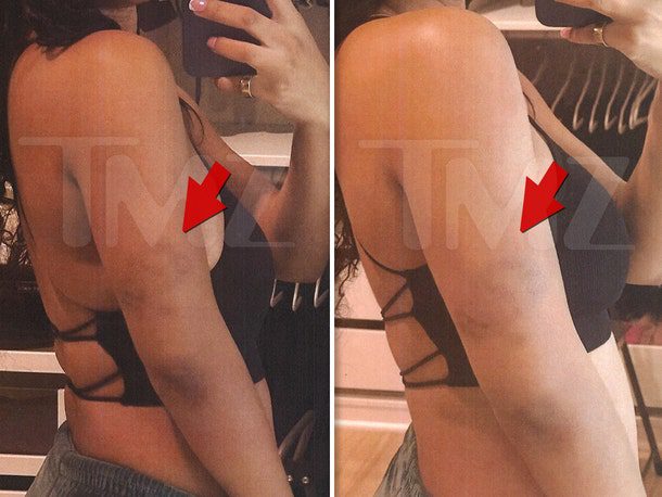 Halle Bailey Photographic evidence of injuries was submitted to law enforcement as part of her request for a restraining order.