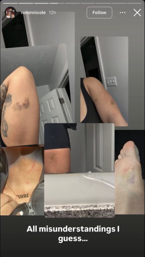 Photos of bruises allegedly sustained in Tremell Rashaud McKinney assault on a female case
