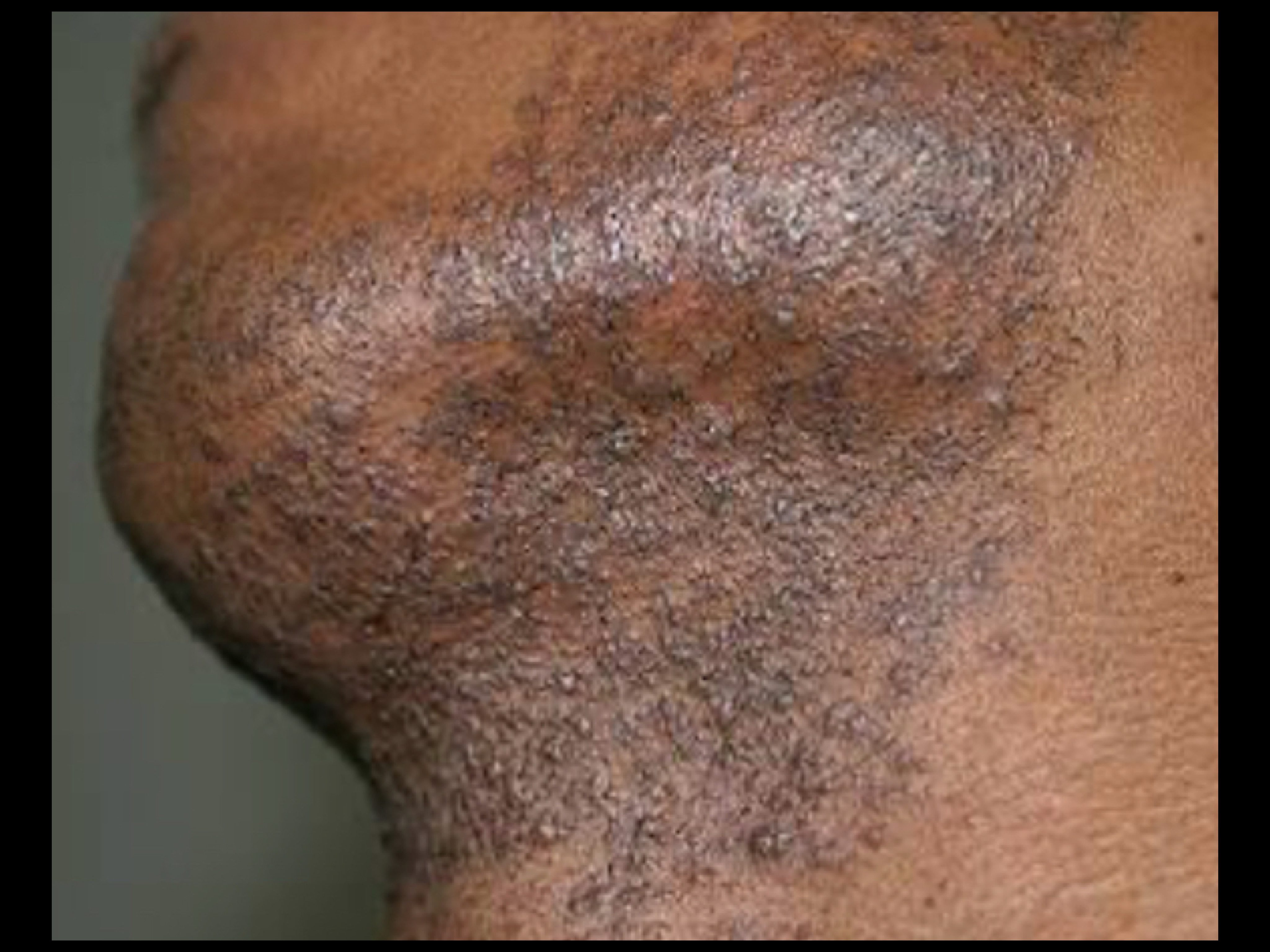 Black Marines razor bumps policy