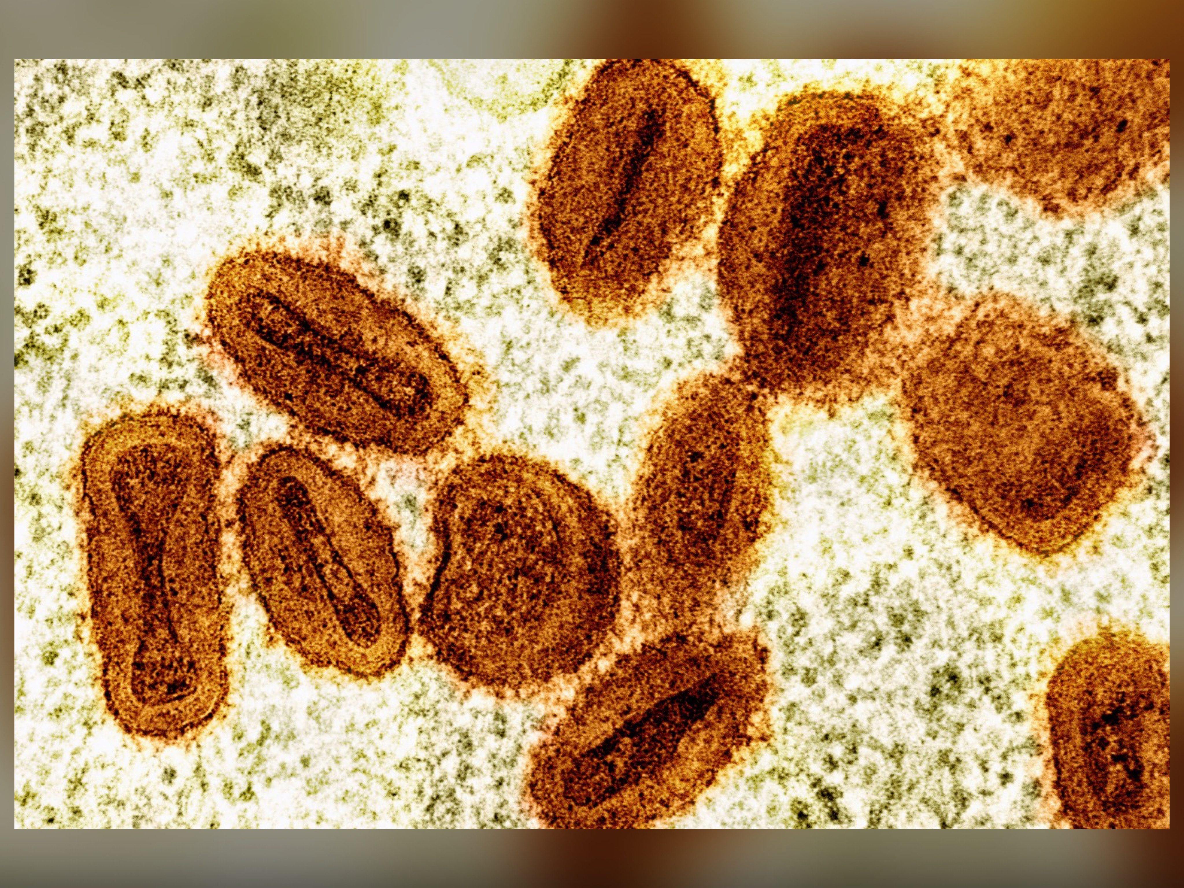 Clade I mpox detected in North Carolina