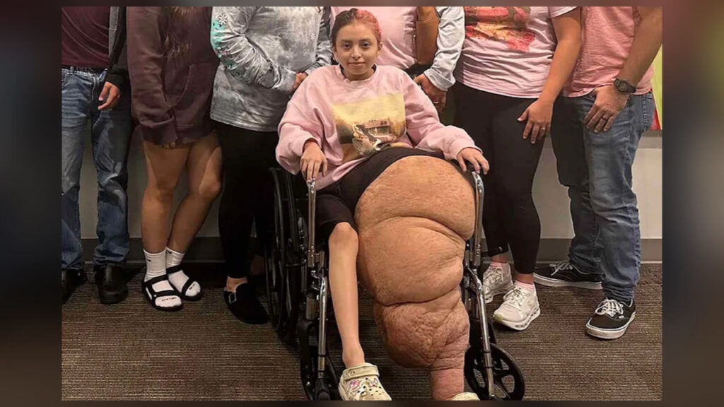 Florida teen rings victory bell after surviving rare leg condition and life-saving amputation